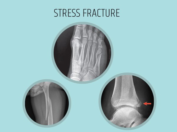 आखिर क्या है स्ट्रेस फ्रैक्चर?